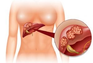 Лікування раку печінки в Німеччині сучасними методами