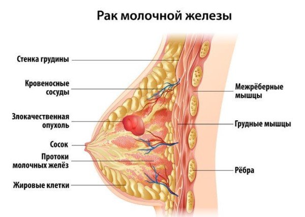 Онкомаркери на рак молочної залози