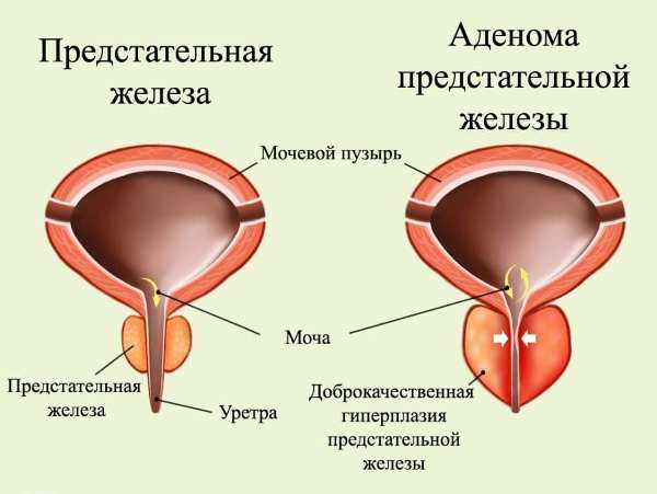 Аденома передміхурової залози: що це, лікування і дієта