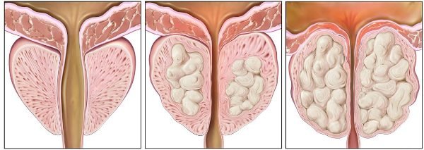 Аденома передміхурової залози: що це, лікування і дієта