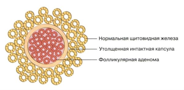 Симптоми і лікування аденоми щитовидної залози