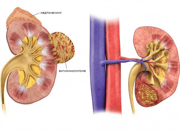 Ангіоліпоми нирок, печінки, хребта