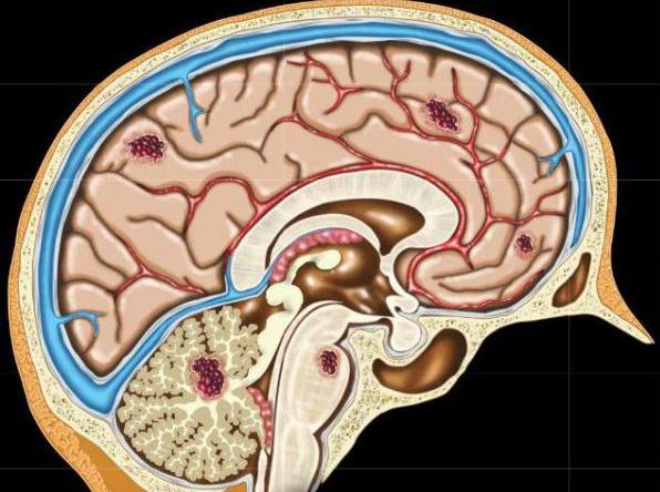Кавернома головного і спинного мозку
