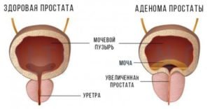 Види і причини аденоми