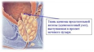 Види і причини аденоми