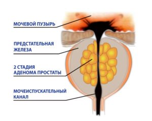 Види і причини аденоми