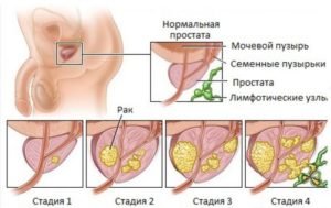 Види і причини аденоми