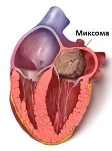 Міксома - що це таке?