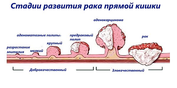 Аденокарцинома прямої кишки: причини, симптоми і лікування