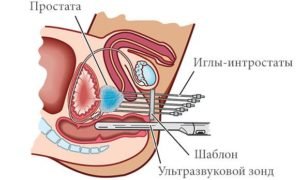 Брахітерапія раку передміхурової залози