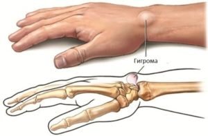 Гігрома кисті руки