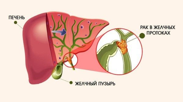 Рак жовчних проток - що це?