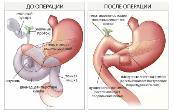 Рак жовчних проток - що це?