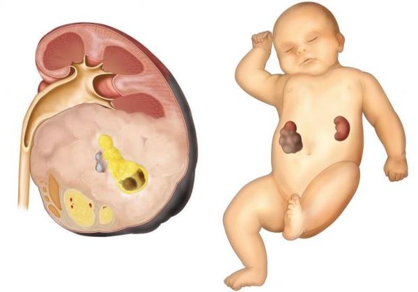 Нефробластома - що це таке?