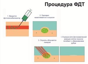 Фотодинамічна терапія в онкології