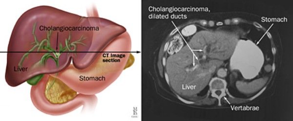Холангіокарцинома печінки - що це?