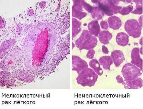 Дрібноклітинний рак легені - що це?