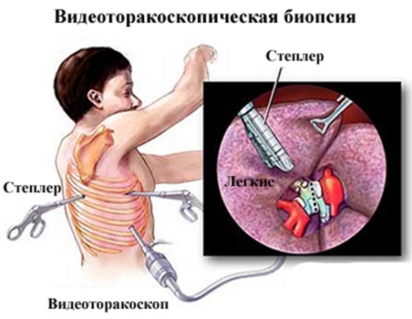 Дрібноклітинний рак легені - що це?