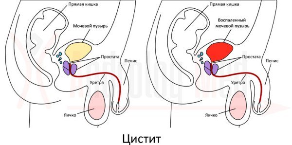 Ознаки раку сечового міхура у чоловіків і виживання