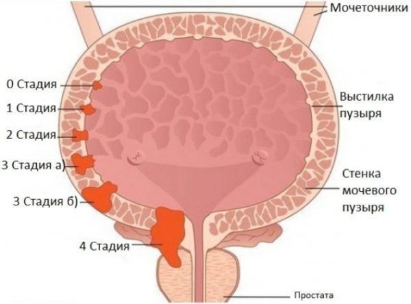 Ознаки раку сечового міхура у чоловіків і виживання