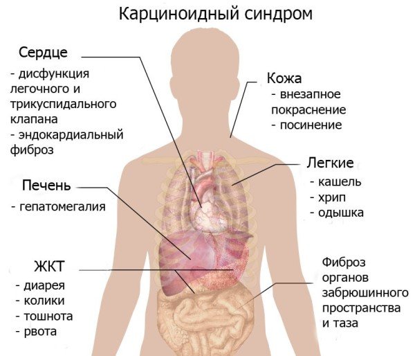 Карциноїдний синдром - що це таке, лікування та прогноз