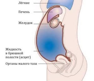 Причини і прогноз асциту черевної порожнини при онкології