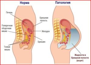 Причини і прогноз асциту черевної порожнини при онкології