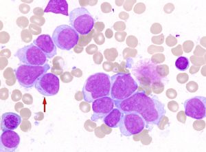 Мієлоїдний лейкоз - що це таке?
