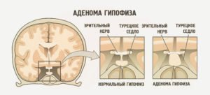 Аденома гіпофіза - що це таке, діагностика та видалення