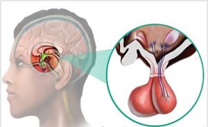 Аденома гіпофіза - що це таке, діагностика та видалення