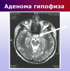 Аденома гіпофіза - що це таке, діагностика та видалення