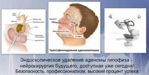 Аденома гіпофіза - що це таке, діагностика та видалення