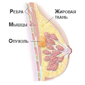 Рак грудей у жінок. Первинна і вторинна профілактика захворювання раку грудини