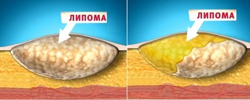 Як виглядає жировик? Видалення і лікування народними засобами