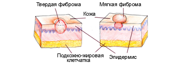 Фіброма шкіри - що це таке?