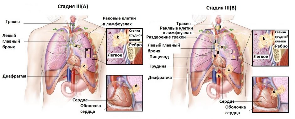 Як виглядає ракова пухлина? Фото злоякісної пухлини. карцинома