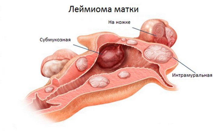 Лейоміома матки як лікувати і наскільки небезпечна? Інтрамуральна і інші види лейоміом