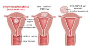 Лейоміома матки як лікувати і наскільки небезпечна? Інтрамуральна і інші види лейоміом