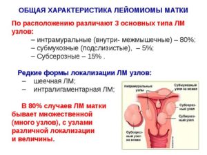 Лейоміома матки як лікувати і наскільки небезпечна? Інтрамуральна і інші види лейоміом