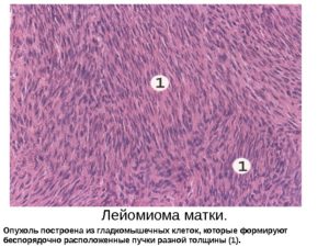 Лейоміома матки як лікувати і наскільки небезпечна? Інтрамуральна і інші види лейоміом