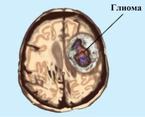 Гліома головного мозку - що це таке і прогноз життя