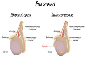 Пухлина яєчка - лікування, профілактика і фото