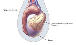 Пухлина яєчка - лікування, профілактика і фото