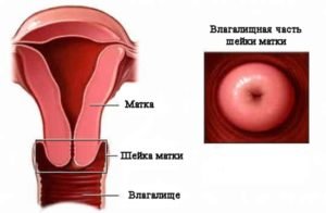 Симптоми і ознаки раку шийки матки на ранній стадії