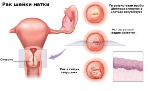 Симптоми і ознаки раку шийки матки на ранній стадії