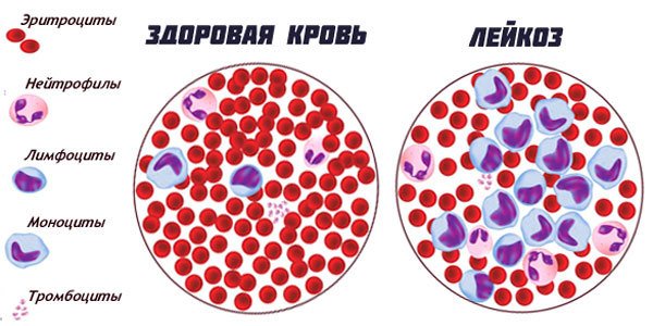 Скільки живуть з лейкозом? Причини лейкозу, аналізи, діагностика та лікування.