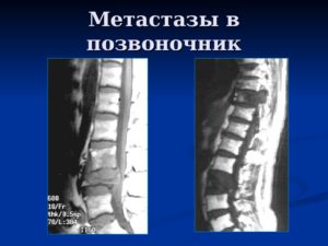 Метастази в хребті: тривалість життя, фото