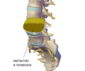 Метастази в хребті: тривалість життя, фото