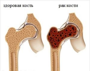 Що таке саркома кістки? Лікування, стадії і скільки живуть при захворюванні